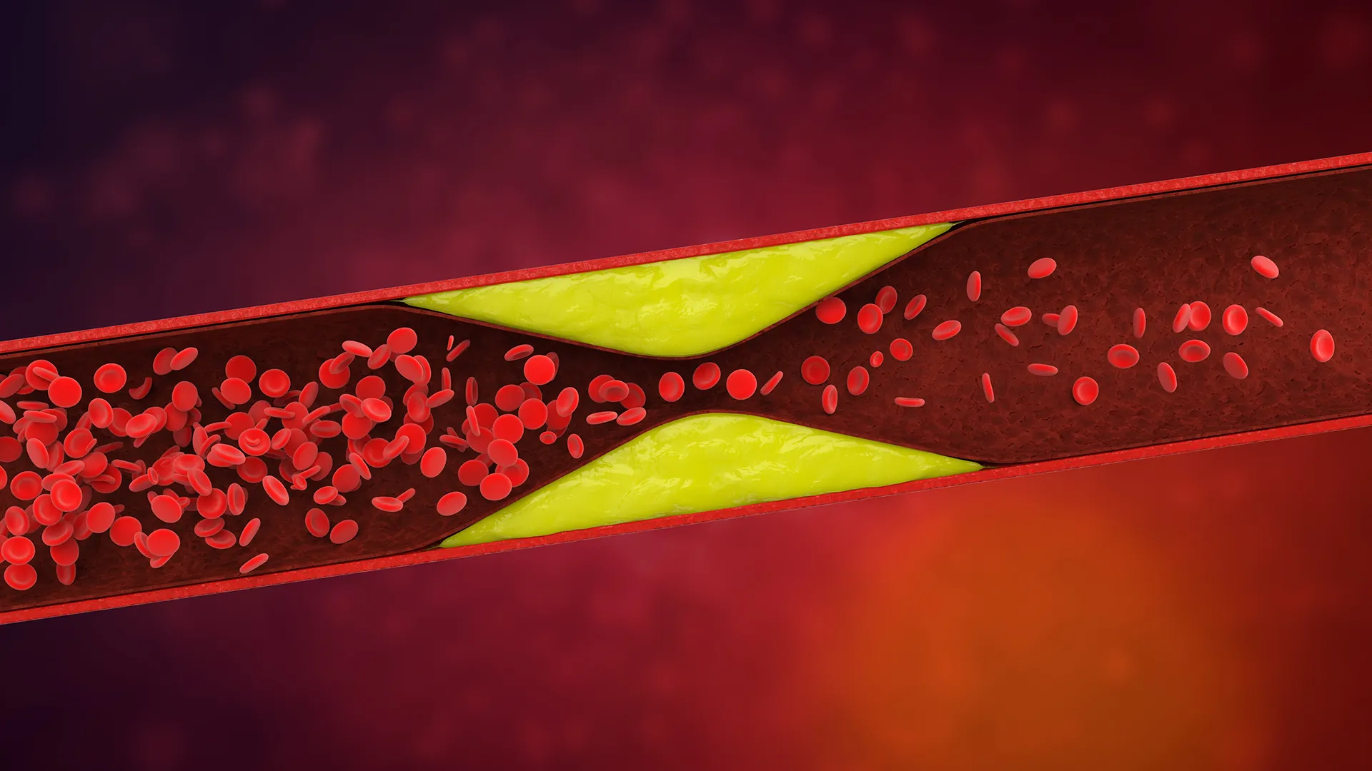 Genetic Mutation Combination Significantly Increases Blood Clot Risk