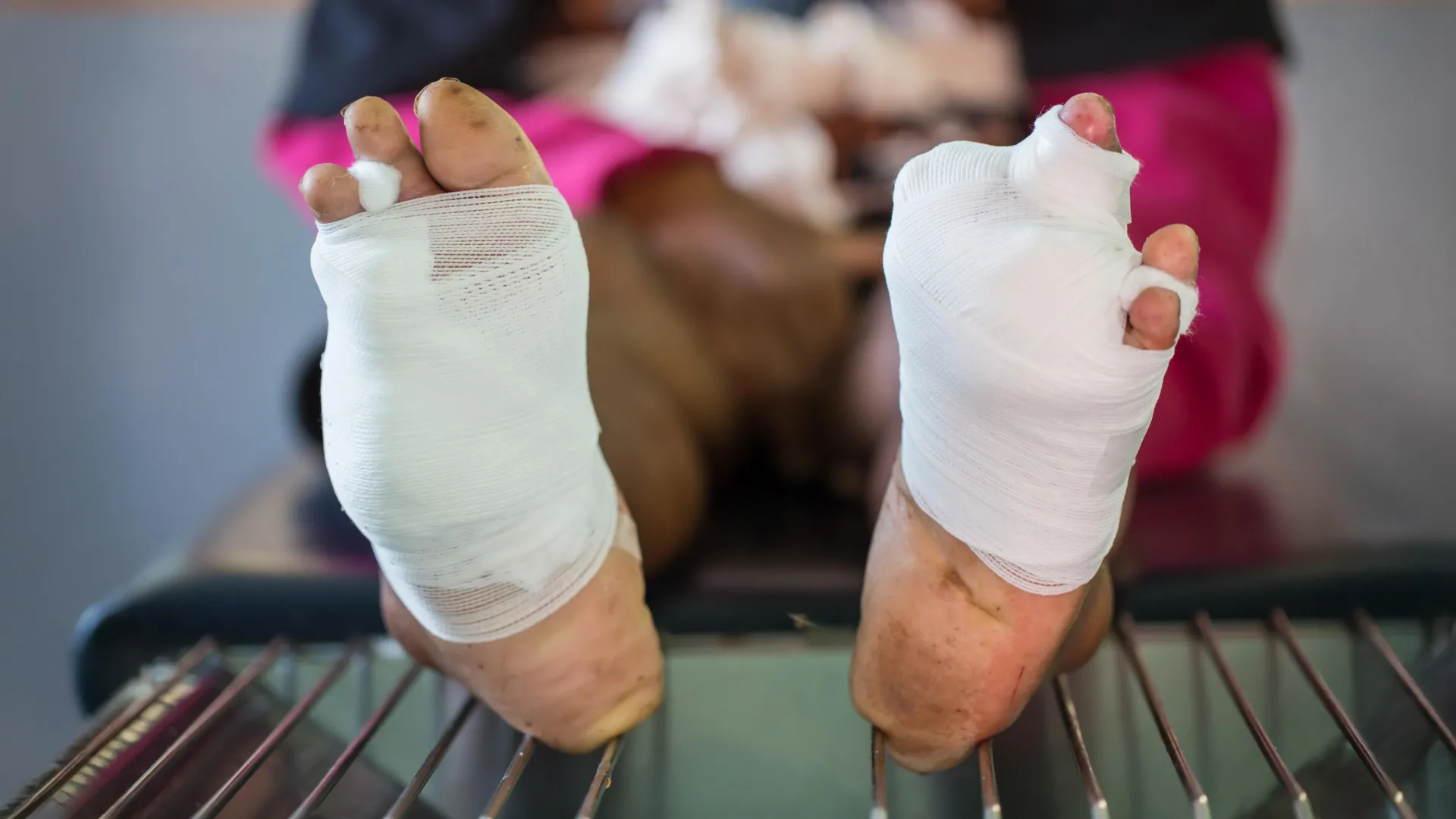 New oxygen gel could prevent amputation in diabetic wound patients